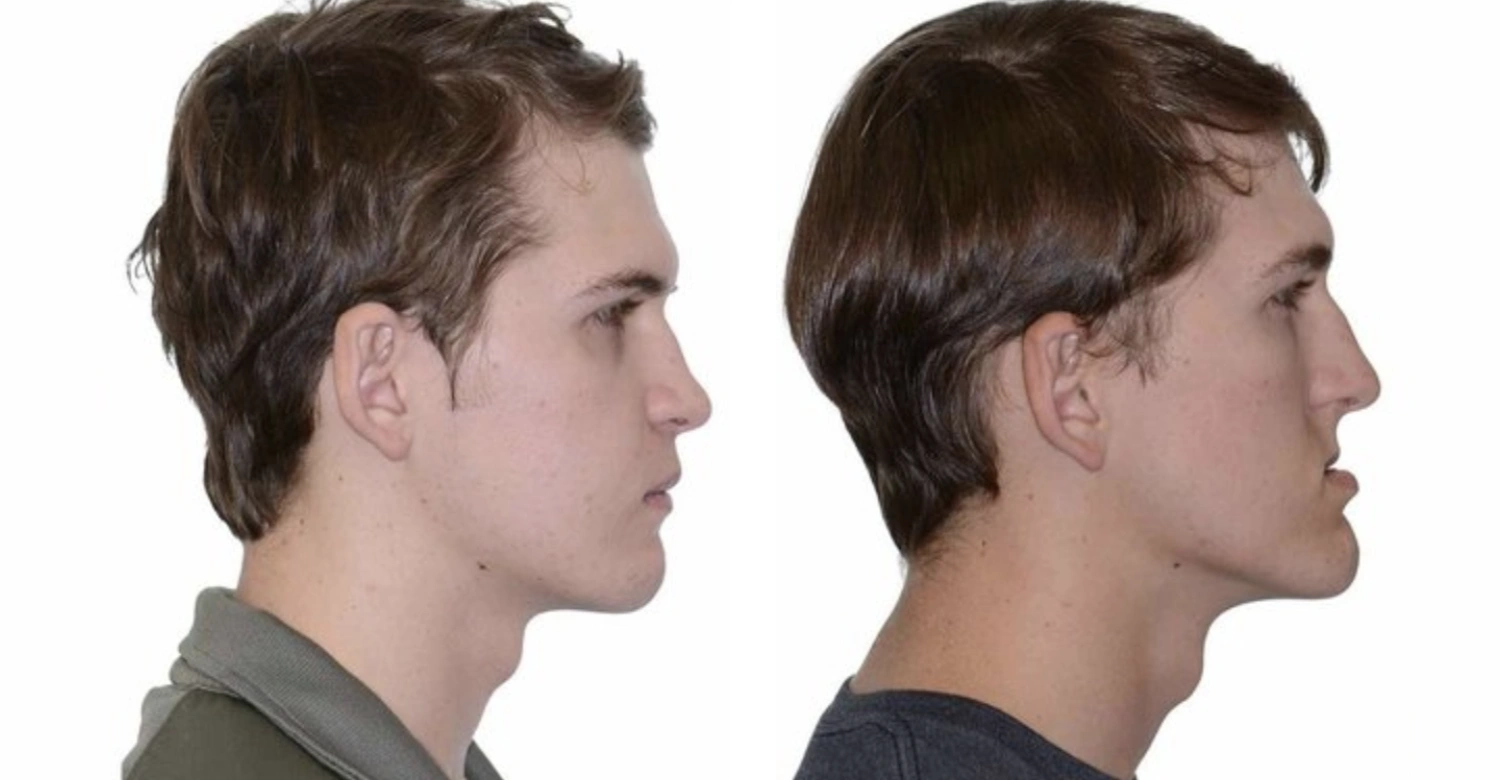 recessed maxilla inblog